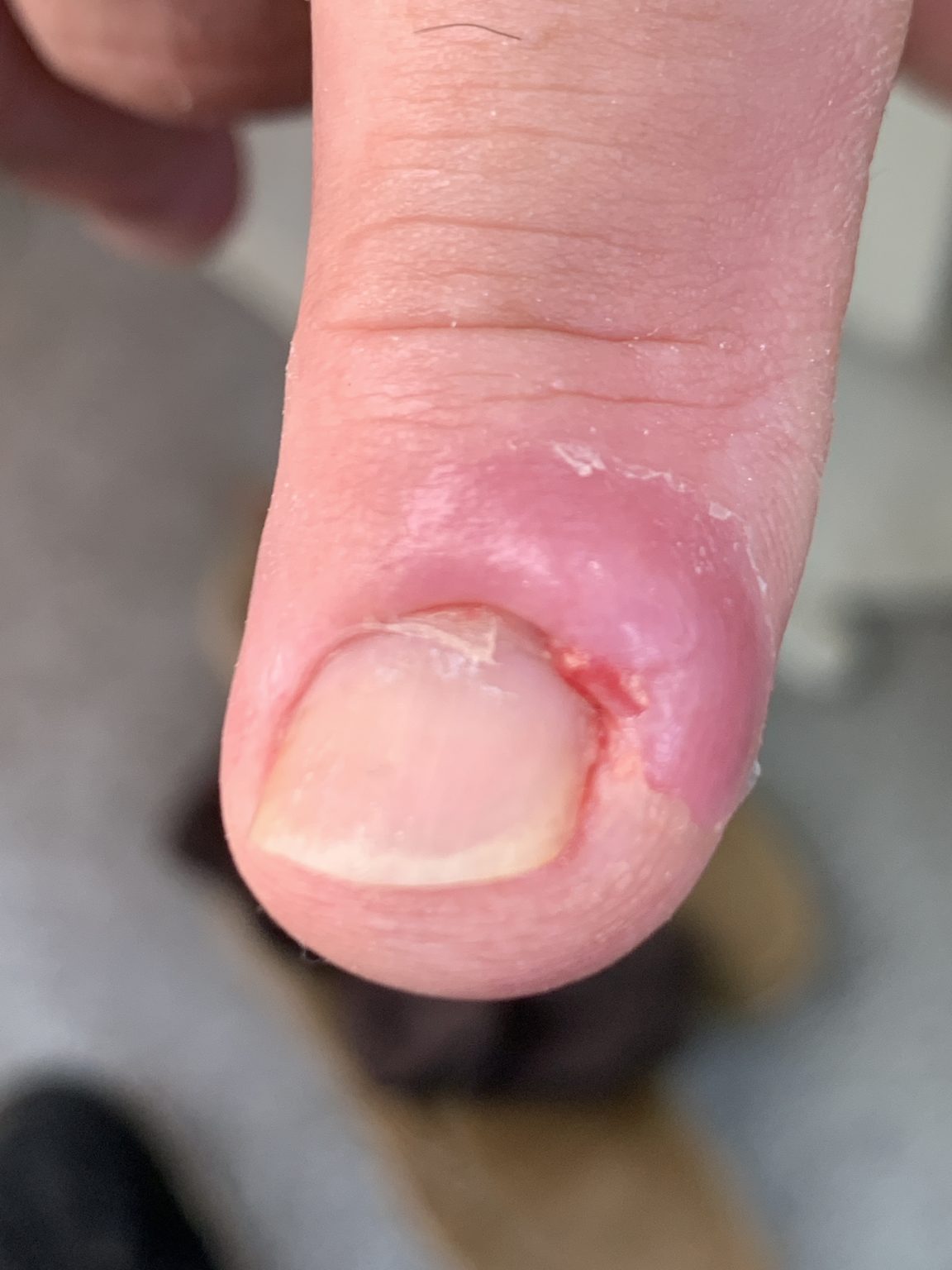 Fingernail infection & wart | A&A Podiatrists & Chiropodists